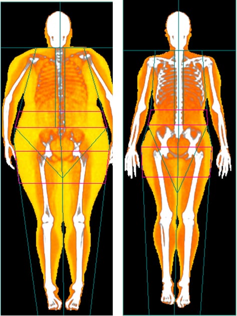 The Top Five Reasons Why You Need A Dxa Scan Body Map 360